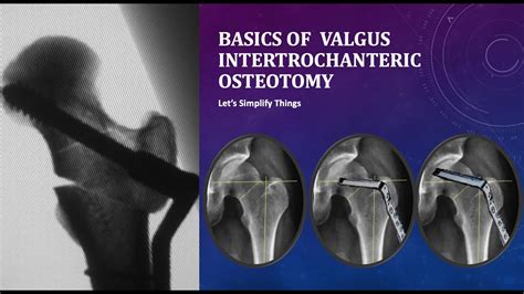 Basics Of Valgus Intertrochanteric Osteotomy For Hip Fractures