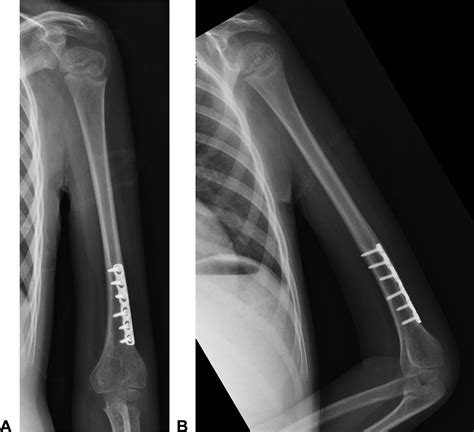 Distal Humerus External Rotation Osteotomy For Hand Position In