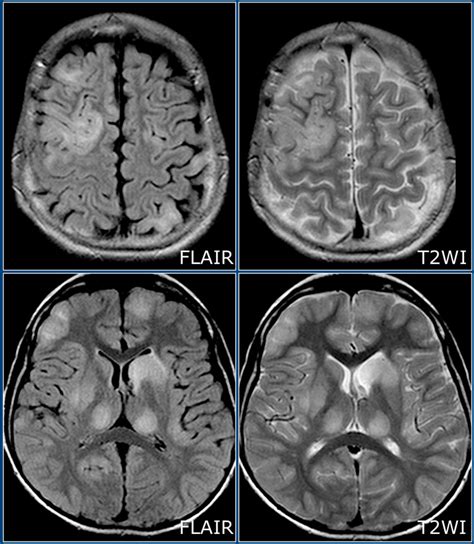 The Radiology Assistant Multiple Sclerosis