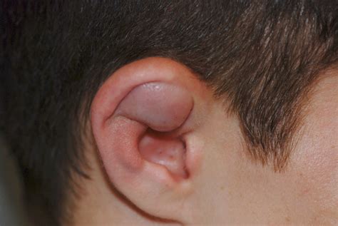 Auricular Hematoma Treatment