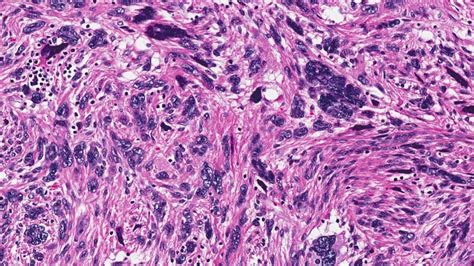 Leiomyoma | Atlas of Pathology