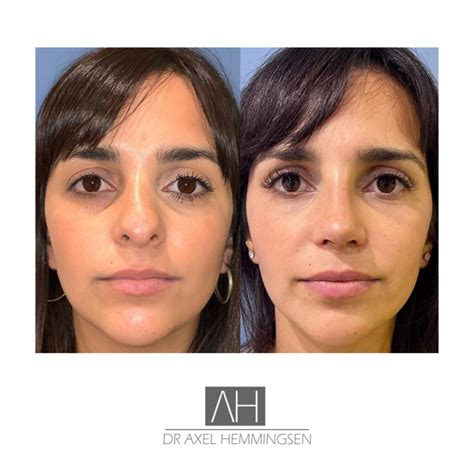 Rinoplastia Precio Buenos Aires Argentina Dr Axel Hemmingsen