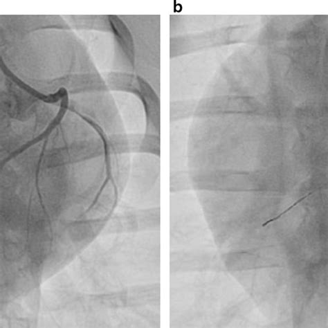 Coronary angiogram. a Prior to occlusion, b Successful LAD coronary ...