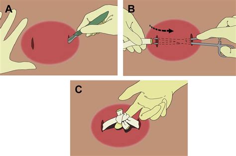 Skin And Soft Tissue Infections Physician Assistant Clinics