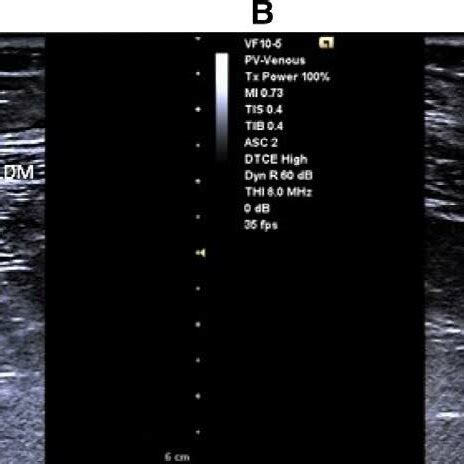 Quadratus Lumborum Block-2. (A) An ultrasound-visible block needle was... | Download Scientific ...