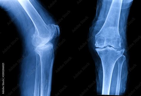 Osteoarthritis Oa Knee Film X Ray Ap Anterior Posterior And