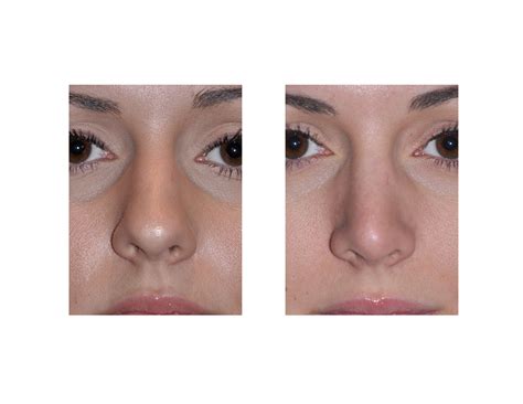 Blog Archivecase Study Rhinoplasty For The Greek Nose