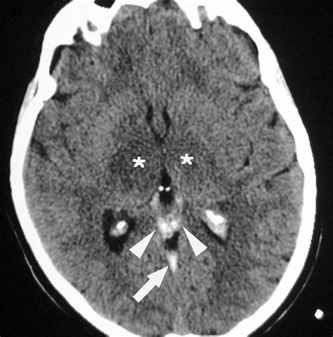 Cerebral Venous Thrombosis Ct