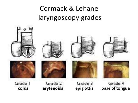 Week 12 Airway Management