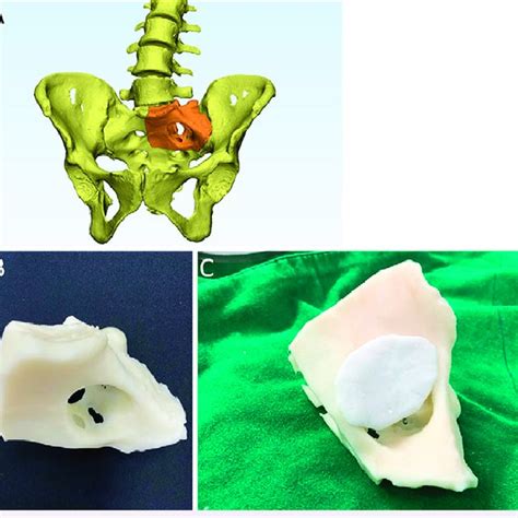 Lumbar MRI Shows Dural Ectasia A And An Anterior Meningocele From The