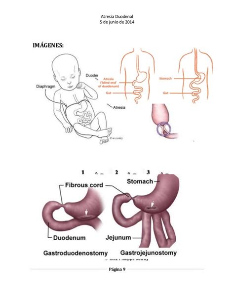 Atresia Duodenal