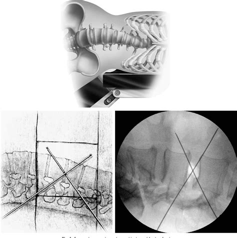 Figure 6 From Extreme Lateral Interbody Fusion XLIF A Novel Surgical