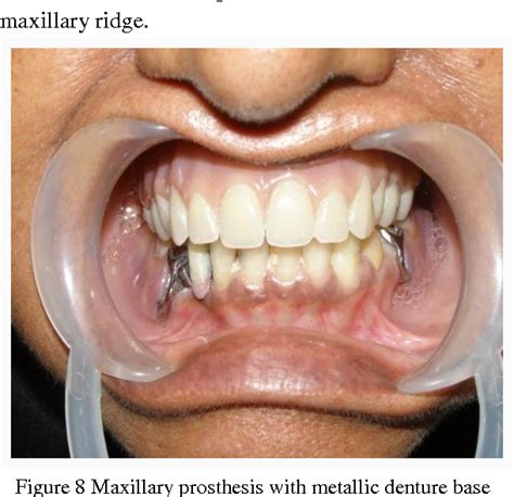 Figure From Prosthodontic Rehabilitation Of Patients With Combination