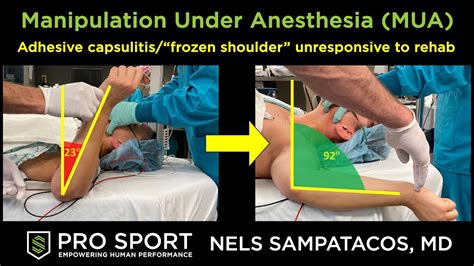 Frozen Shoulder Manipulation Under Anesthesia YouTube