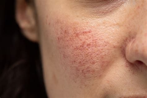 Rosacea Gejala Penyebab Pengobatan Dll Hello Sehat