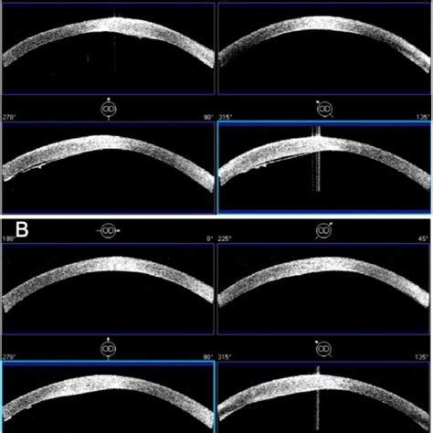 A Visante Anterior Segment Optical Coherence Tomography Asoct Download Scientific Diagram