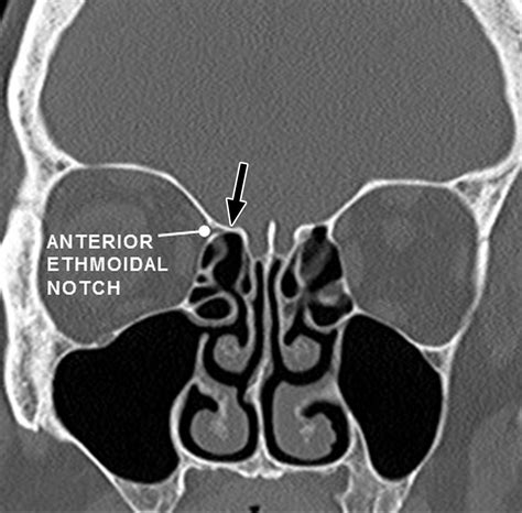 The Preoperative Sinus Ct Avoiding A “close” Call With Surgical