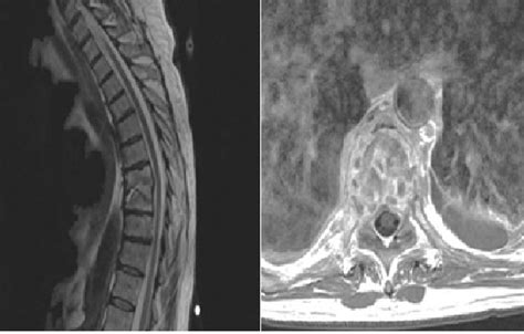 Magnetic Resonance Imaging Of Thoracic Spine With Contrast Show Download Scientific Diagram