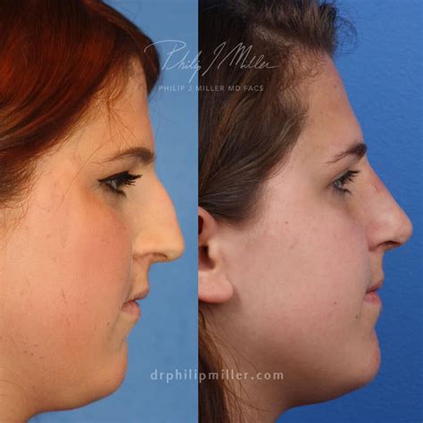 What Is The Best Age For A Nose Job Philip Miller Md