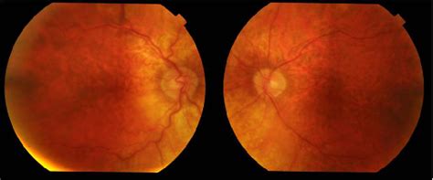 Right A And Left B Retinal Fundus Images Showing Rarefaction Of