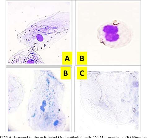 Figure From Genotoxic Effects Of Dental Amalgam Based On Micronucleus