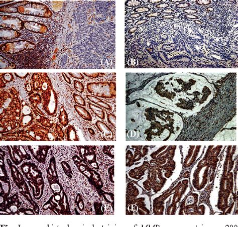 Figure I From Mismatch Repair Genes Expression Defects And Association With Clinicopathological