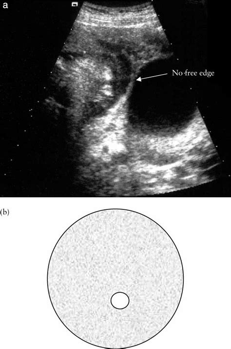 The Amniotic Sheet A Truly Benign Condition Tan 2005 Ultrasound