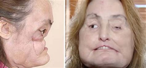 Connie Culp Became The First Ever Face Transplant Patient In The Us