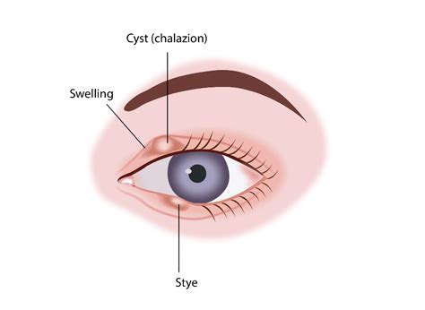 Meibomian Gland Cyst