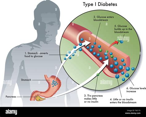 Medical Illustration Of The Symptoms Of Type 1 Diabetes Stock Vector