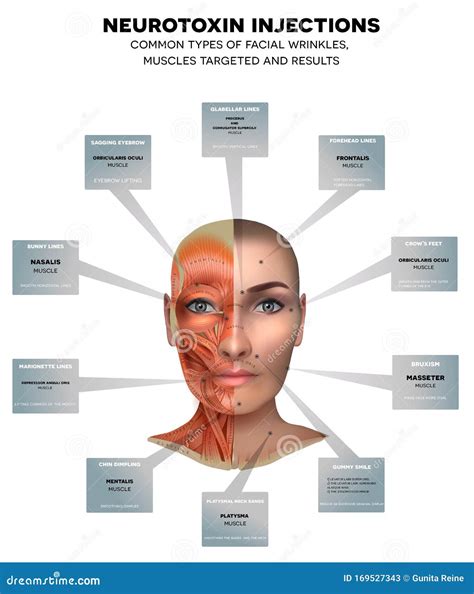 Injections for Facial Wrinkles Stock Vector - Illustration of bands