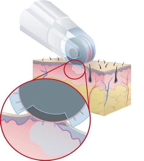 Dermafrac No1 Injektor Na Svetu Genesis Biosystems Kozmetički