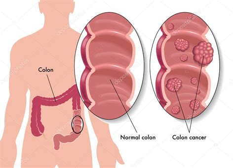 Colon Cancer Stock Illustration By ©rob3000 60338347