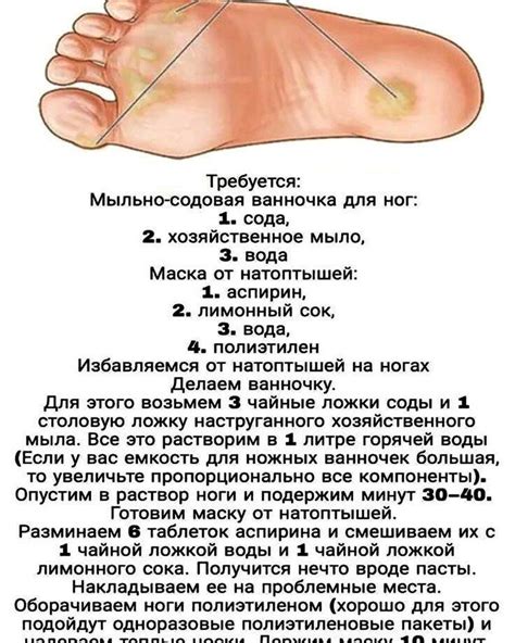 Мозоли на ногах - виды, причины, лечение и удаление