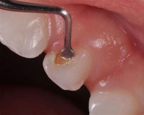 Curso Basta Del Grito Dentinario Remoci N Selectiva Del Tejido Cariado