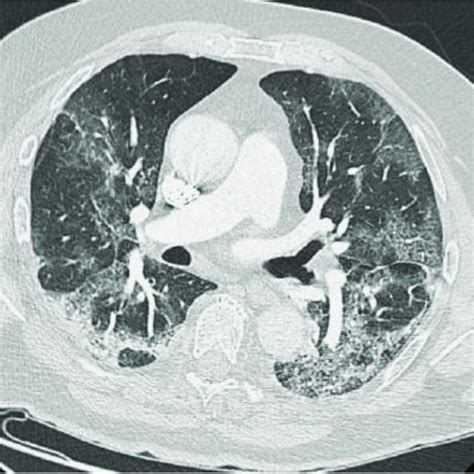 Ct Scan Showing Bilateral Multilobar Ground Glass Opacities And Download Scientific Diagram