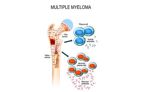 Multiple Myeloma Types Causes Symptoms Diagnosis And Treatment