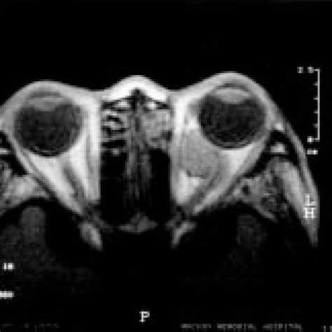 A retrobulbar tumor, shown on MRI, displacing the optic nerve upward ...