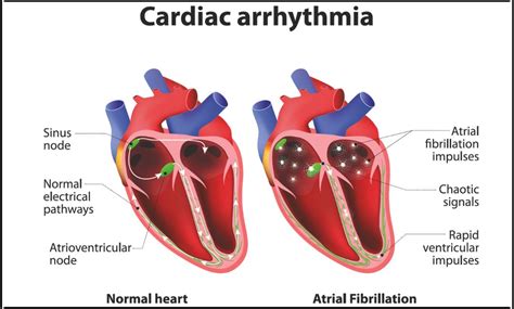 Heart Arrhythmia Causes Risk Factors Symptoms Treatment