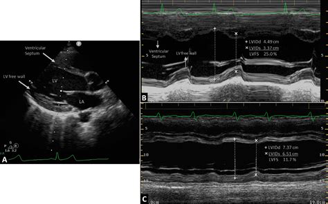 Echocardiographic Applications Of M Mode Ultrasonography In