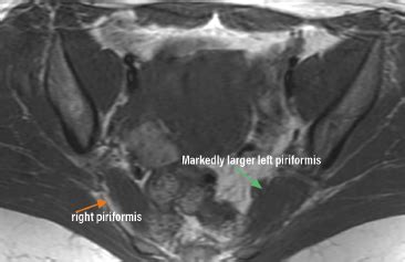 From Piriformis Syndrome to Deep Gluteal Syndrome - Practical Neurology