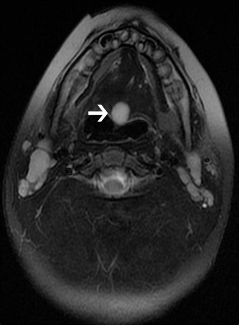 Congenital Oral Masses An Anatomic Approach To Diagnosis Radiographics