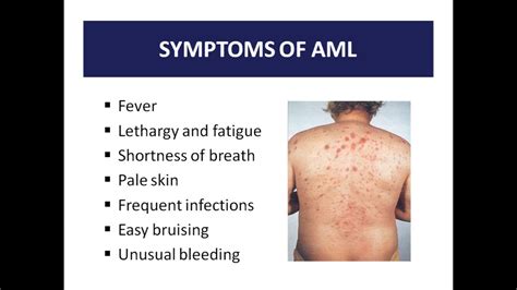 Case Study Acute Myeloid Leukemia Youtube