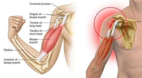 Biceps Tendonitis Symptoms Causes Treatment By Shoulder Braces