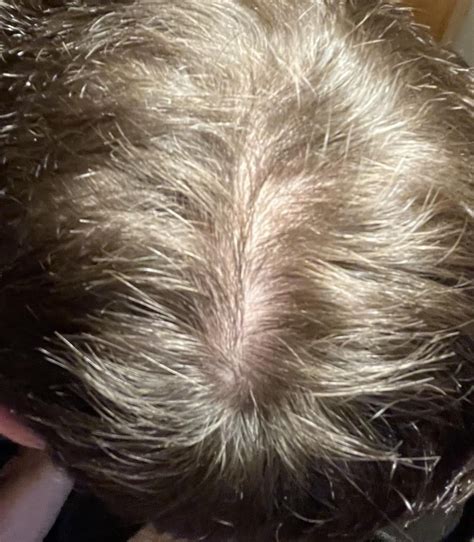 bald spot? : r/Hairloss