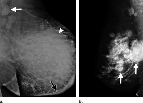 Pdf What Radiologists Need To Know About Diagnosis And Treatment Of Inflammatory Breast Cancer