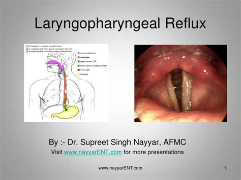 Lpr Laryngopharyngeal Reflux Laryngopharyngeal Reflux