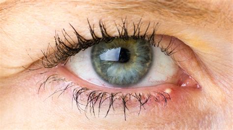 What Causes A Sty In The Eye