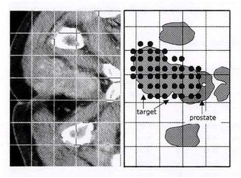 Figure 1 From High Dose Rate HDR Conformal Interstitial Brachytherapy