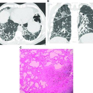 Mages From A Year Old Male With Idiopathic Pulmonary Fibrosis A